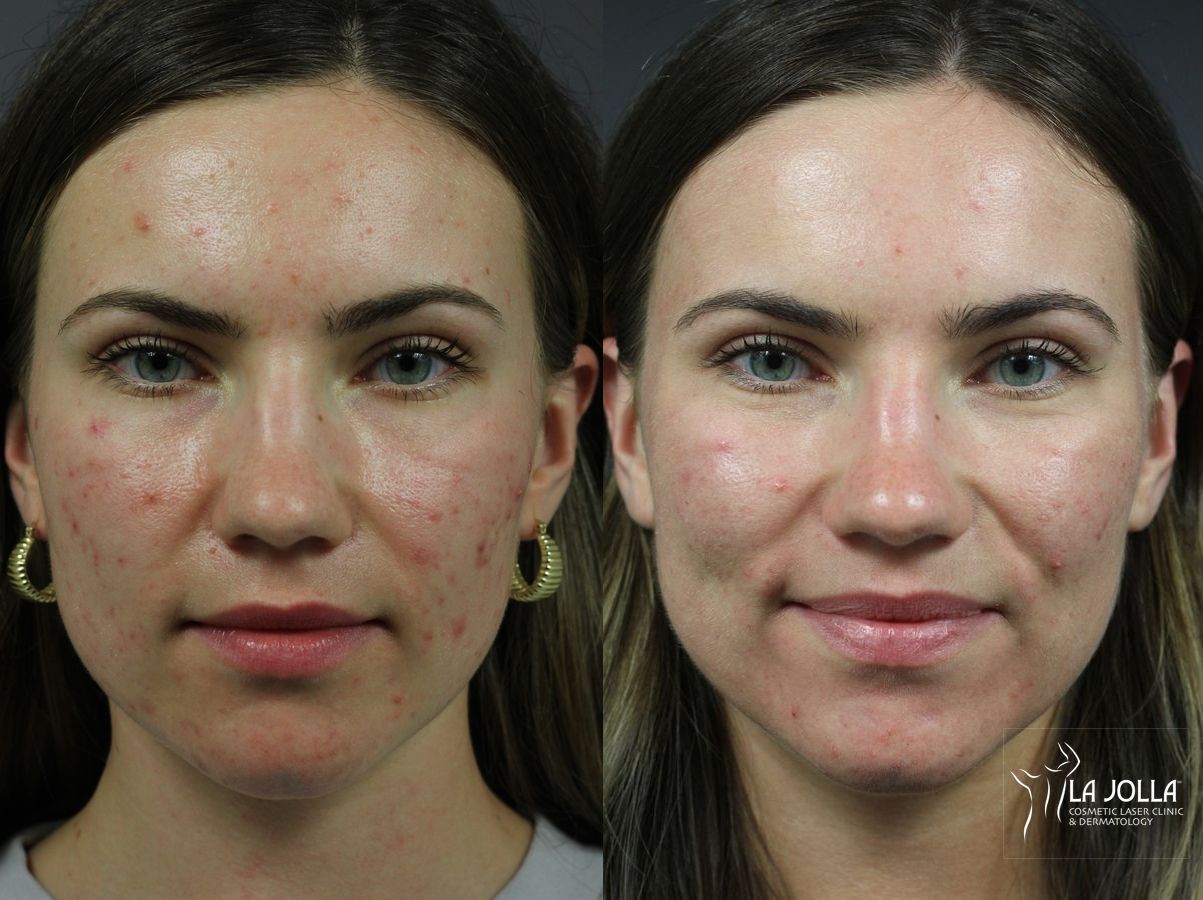 Before and after Acne: Laser Treatment case 36160