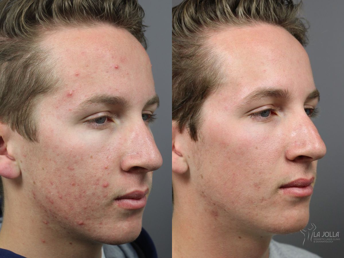 Before and after Acne: Laser Treatment case 36102 - Angle 3