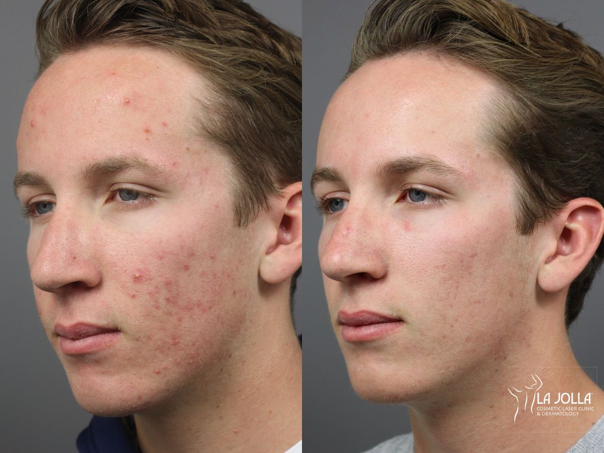 Before and after Acne: Laser Treatment case 36102 - Angle 2
