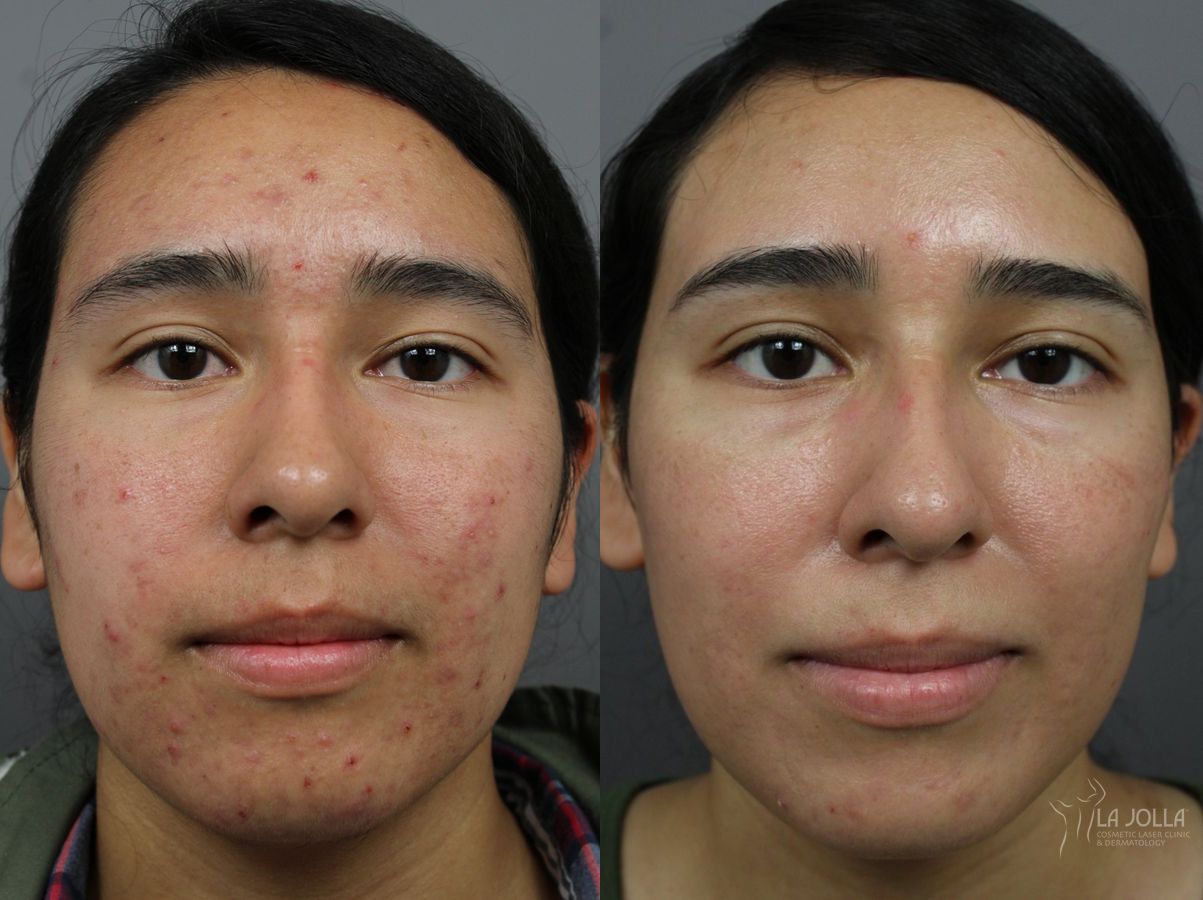 Before and after Acne: Laser Treatment case 36203