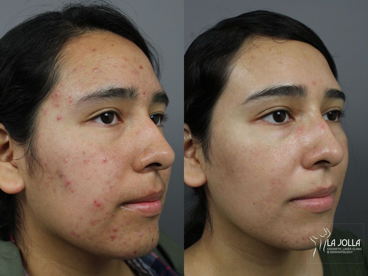 Before and after Acne: Laser Treatment case 36203 - Angle 3