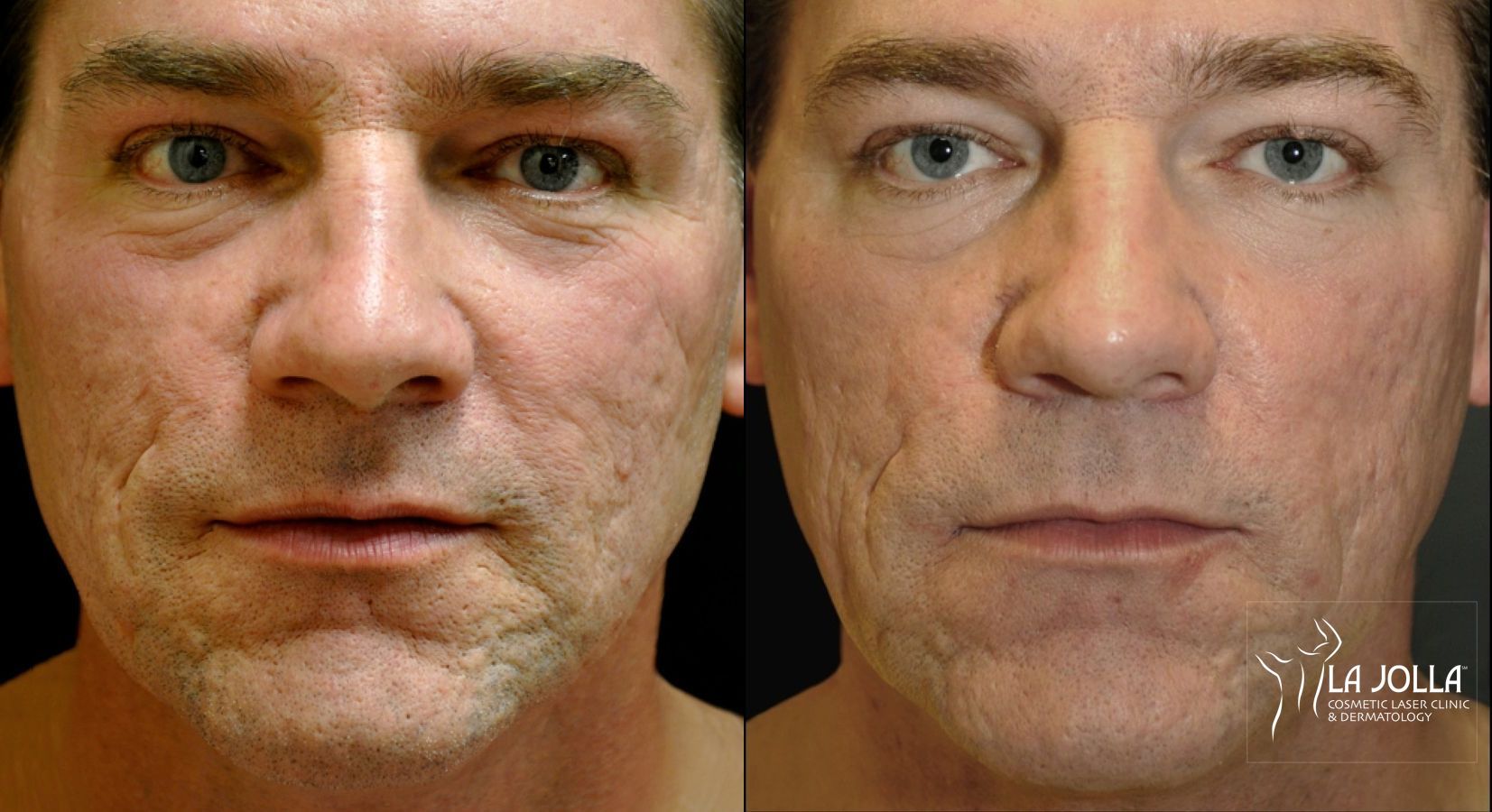 Before and after Acne: Laser Treatment case 36445