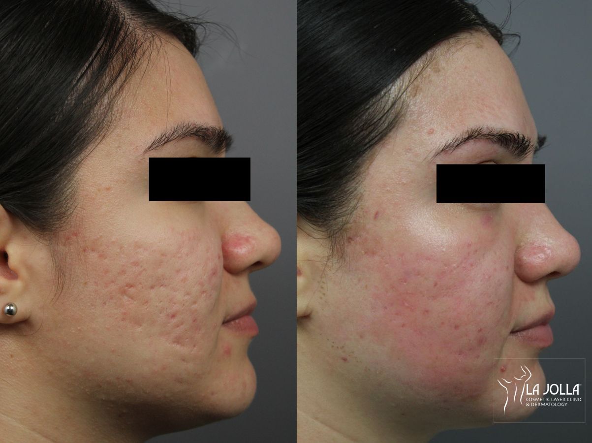Before and after Acne Scars: Subcision case 36222