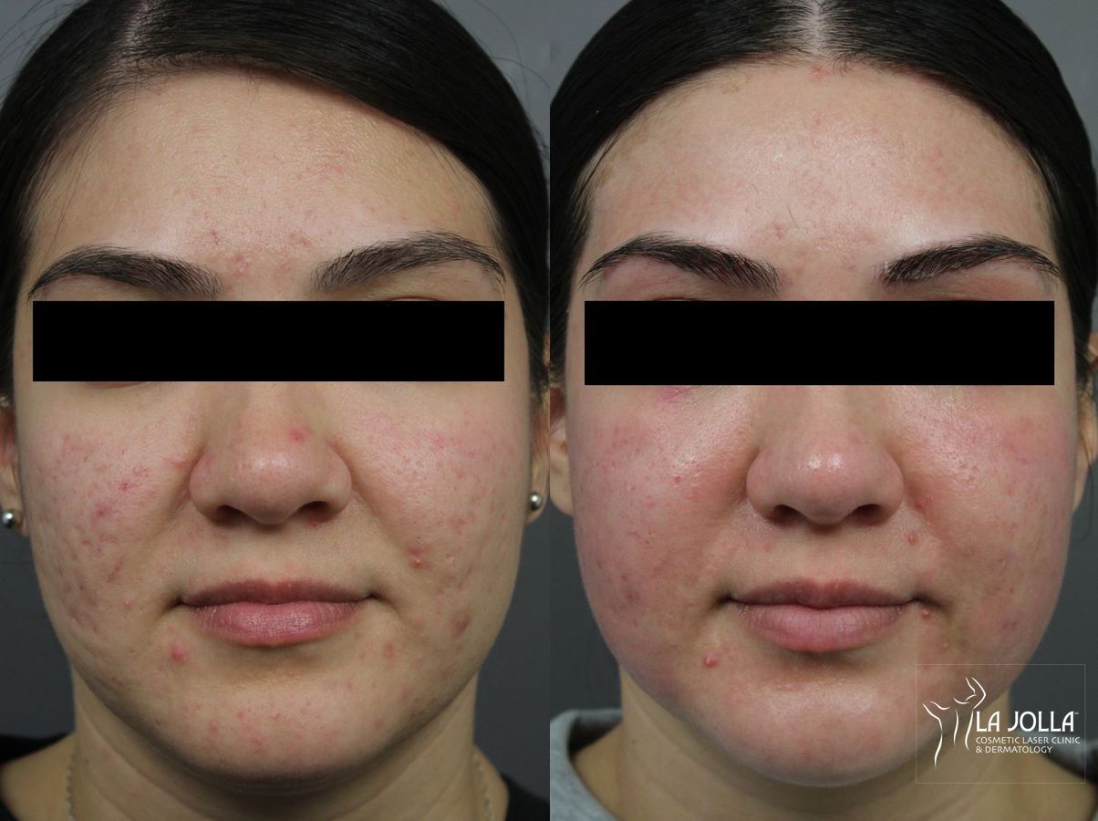 Before and after Acne Scars: Subcision case 36222 - Angle 2