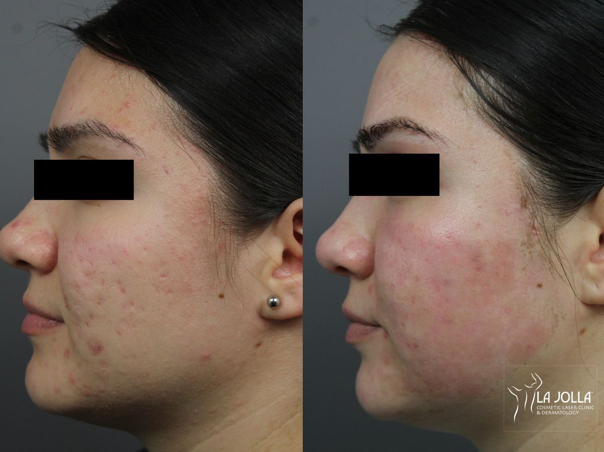Before and after Acne Scars: Subcision case 36222 - Angle 3