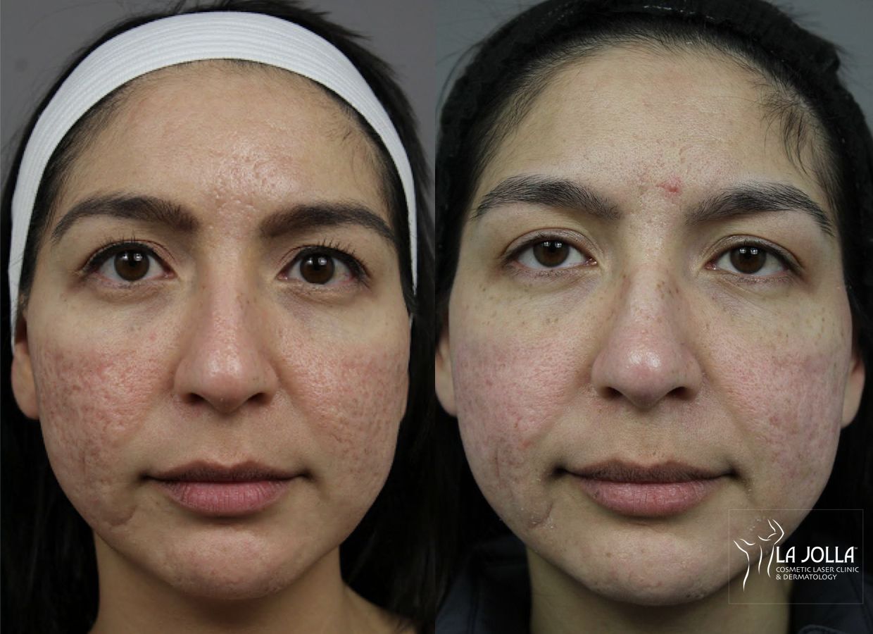 Before and after Acne Scars: Subcision case 36097