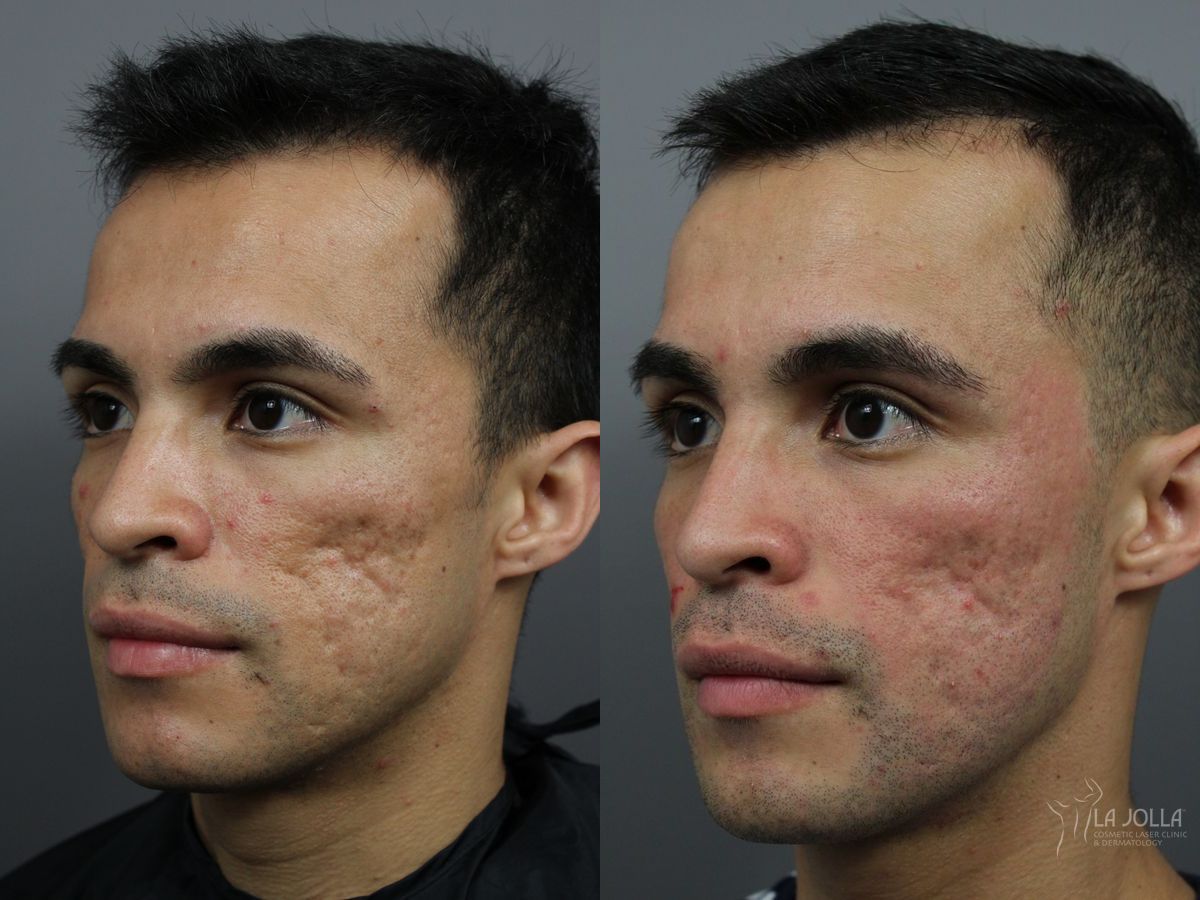 Before and after Acne Scars: Subcision case 36164