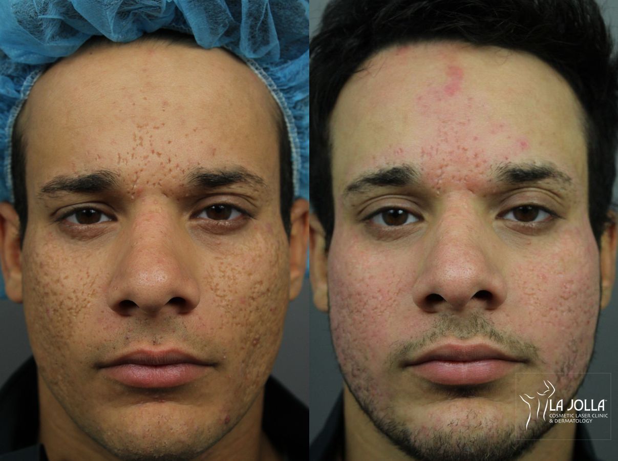 Before and after Acne Scars: Subcision case 36192