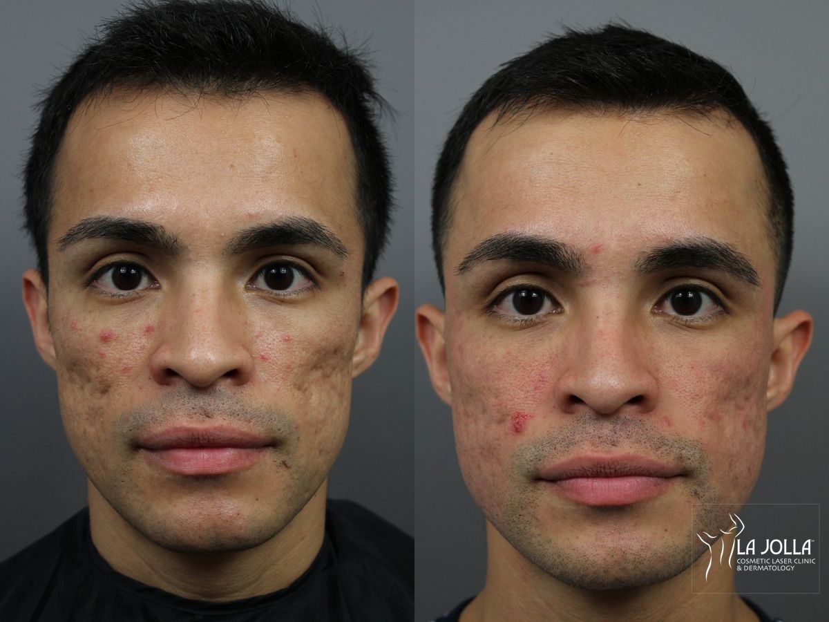 Before and after Acne Scars: Subcision case 36164 - Angle 2
