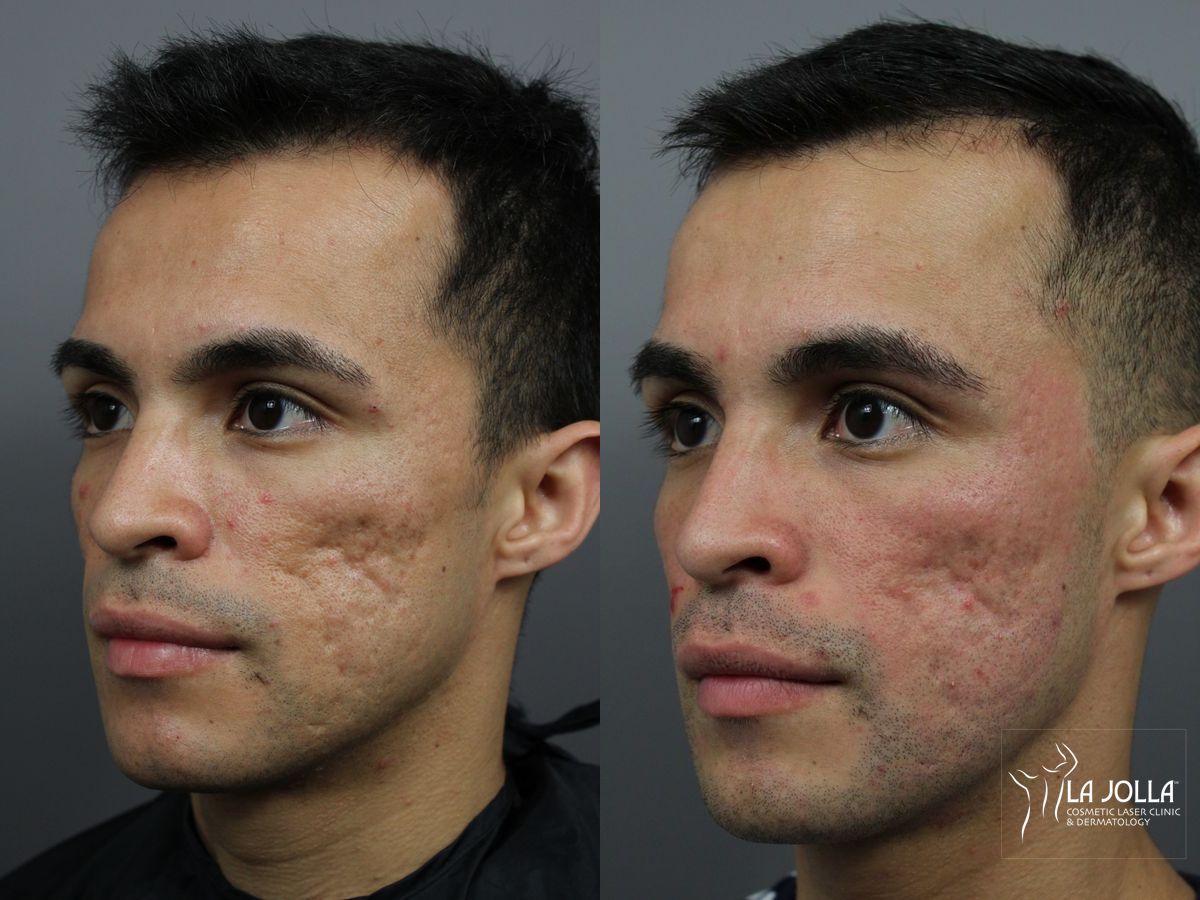 Before and after Acne Scars: Subcision case 36164