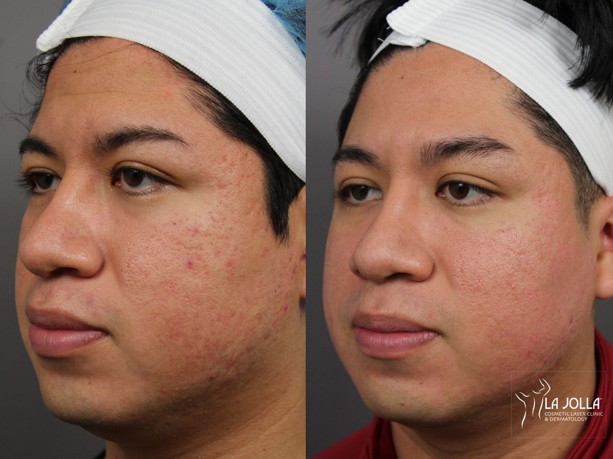 Before and after Acne Scars: Subcision case 36182