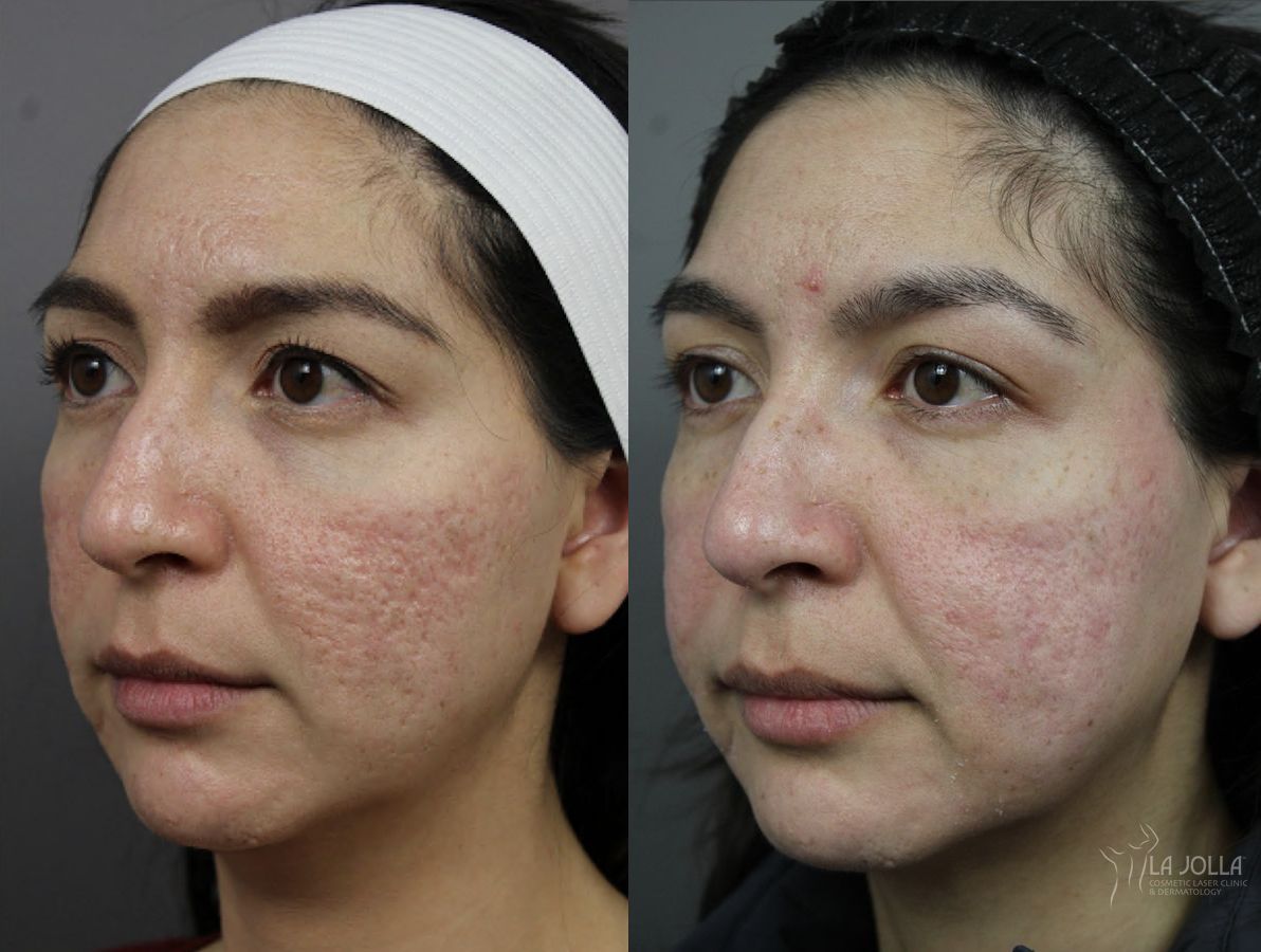 Before and after Acne Scars: Subcision case 36097 - Angle 3