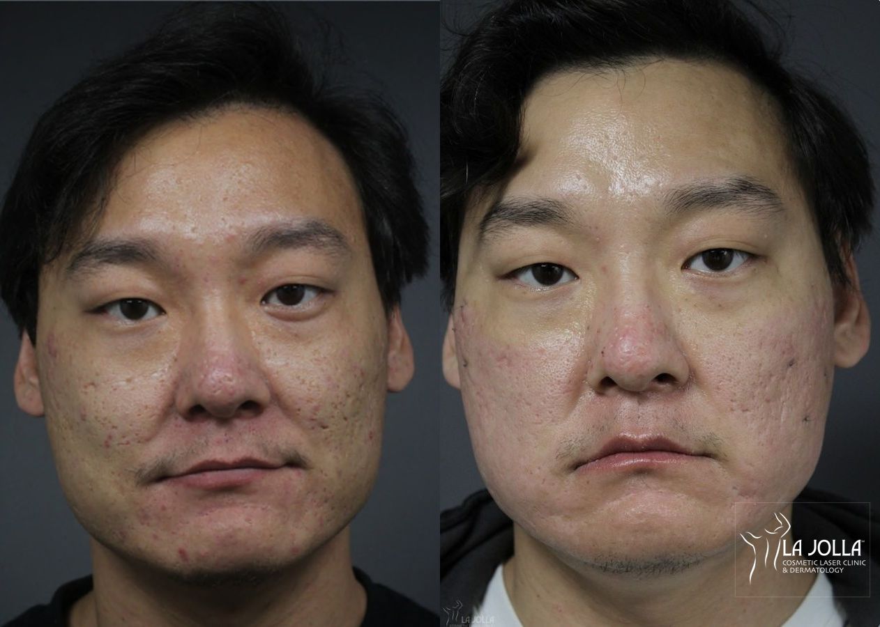 Before and after Acne Scars: Subcision case 36108