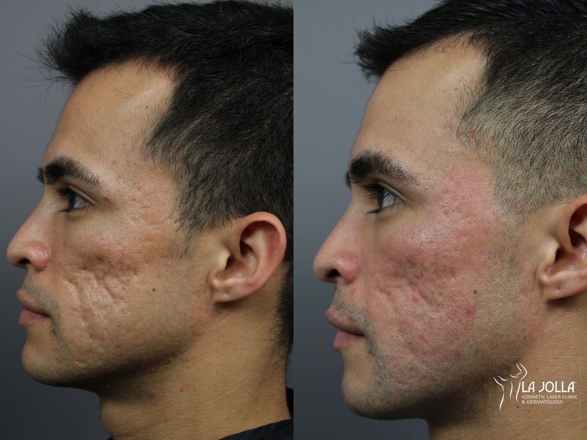Before and after Acne Scars: Subcision case 36164 - Angle 4