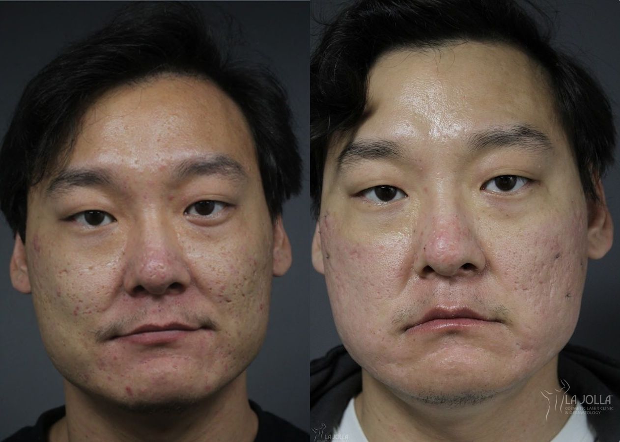 Before and after Acne Scars: Subcision case 36108