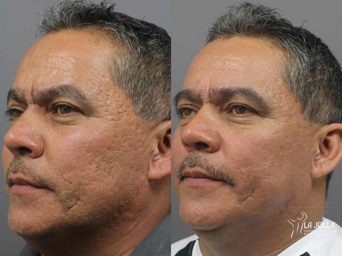 Before and after Acne Scars: Subcision case 36071