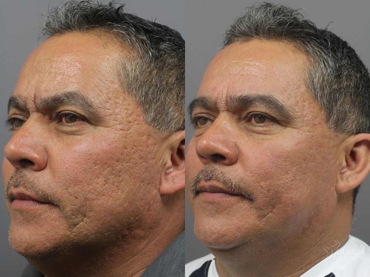 Before and after Acne Scars: Subcision case 36071