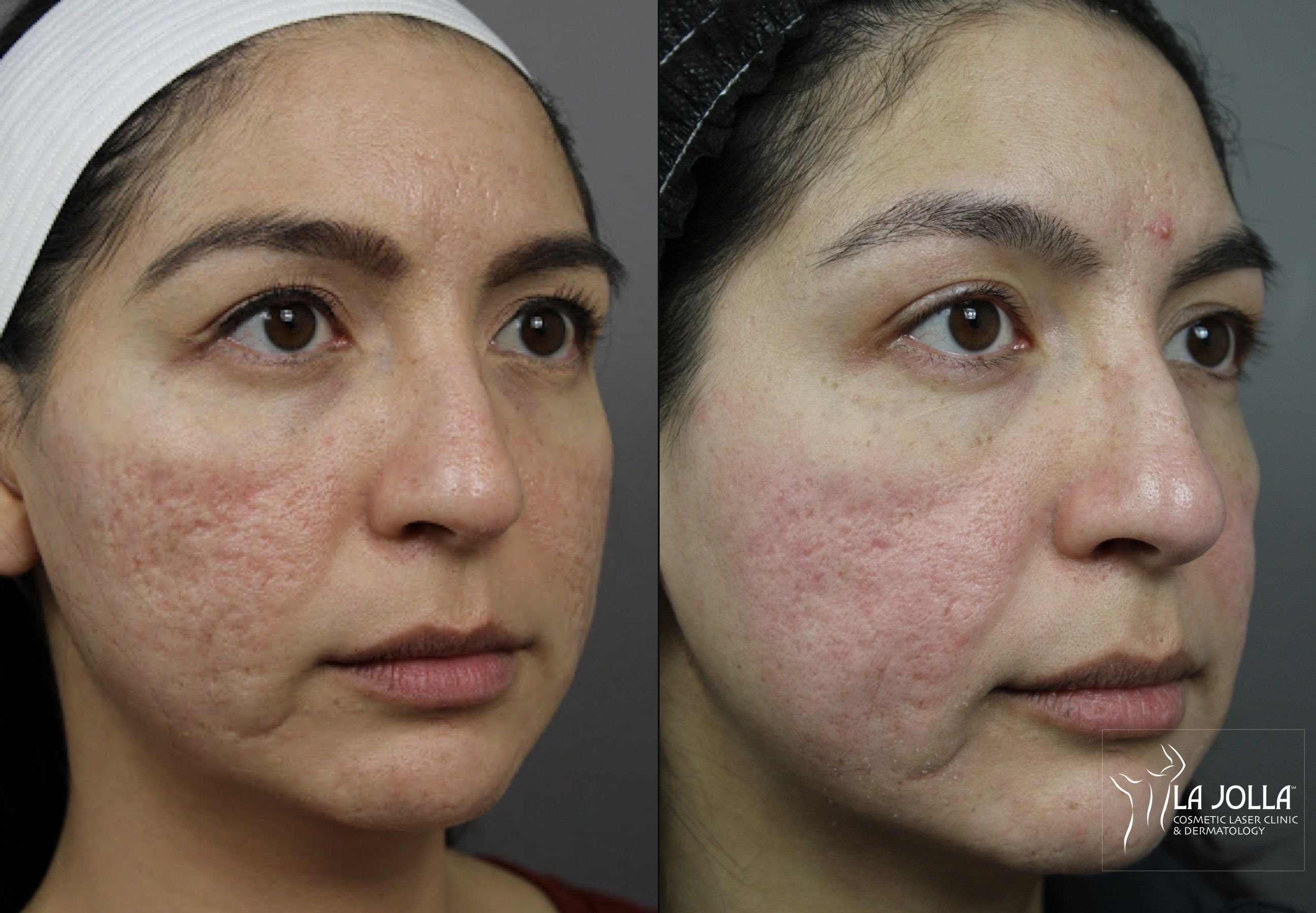 Subcision Skin Changes Acne Scars: Subcision Archives | La Jolla Cosmetic Laser Clinic ...
