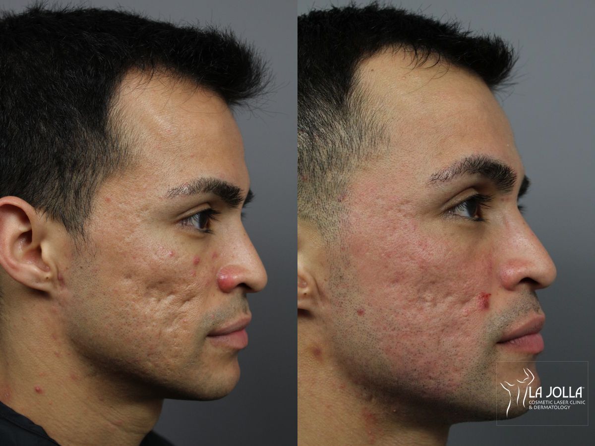 Before and after Acne Scars: Subcision case 36164 - Angle 3