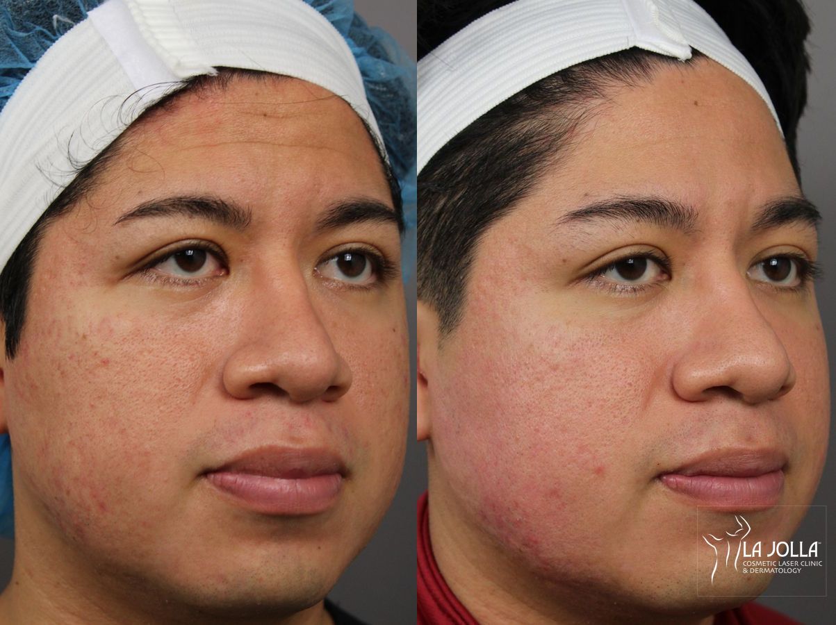 Before and after Acne Scars: Subcision case 36182 - Angle 3