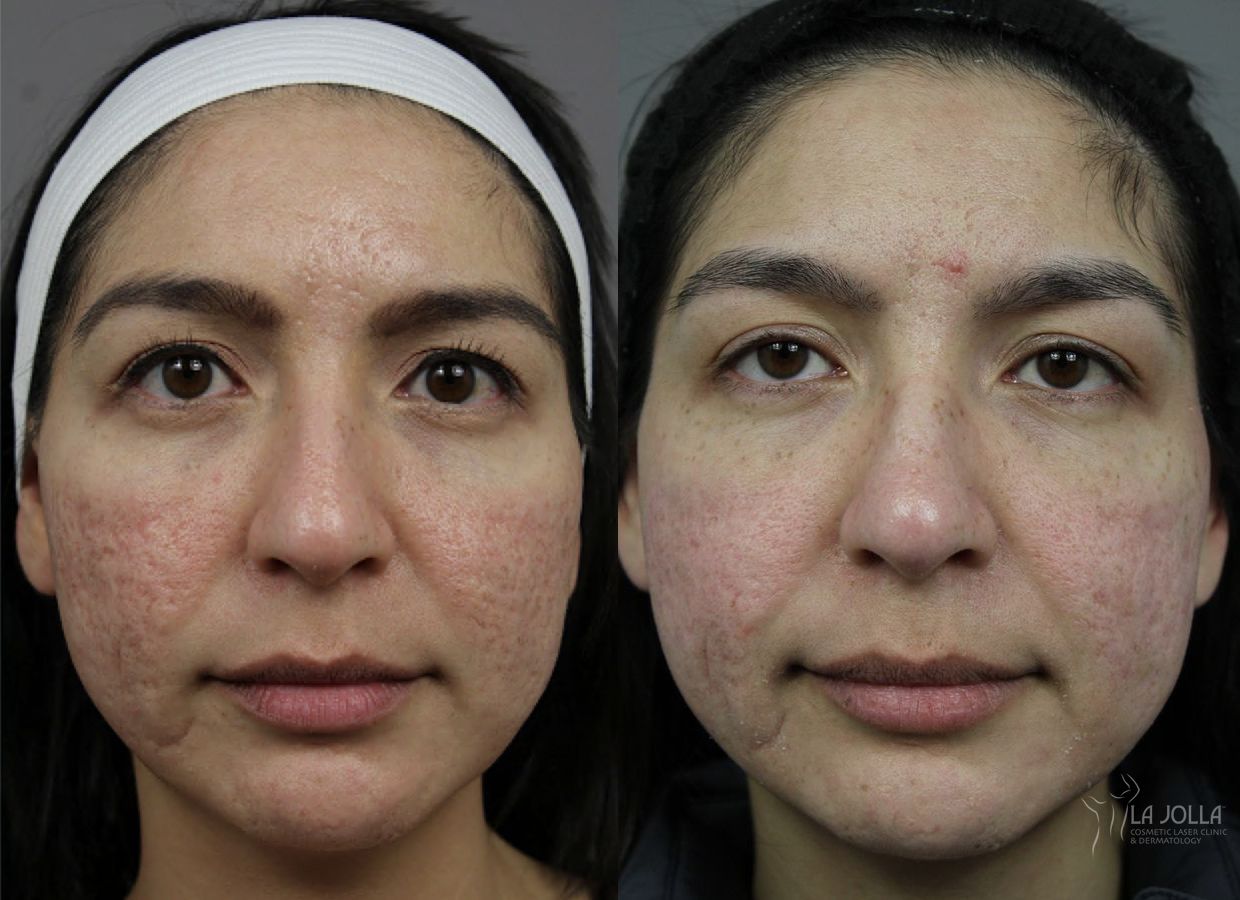 Before and after Acne Scars: Subcision case 36097