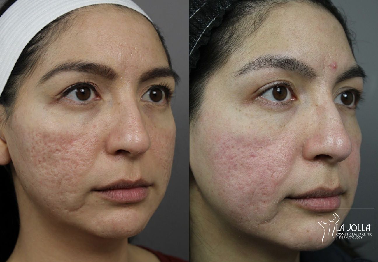 Before and after Acne Scars: Subcision case 36097 - Angle 2