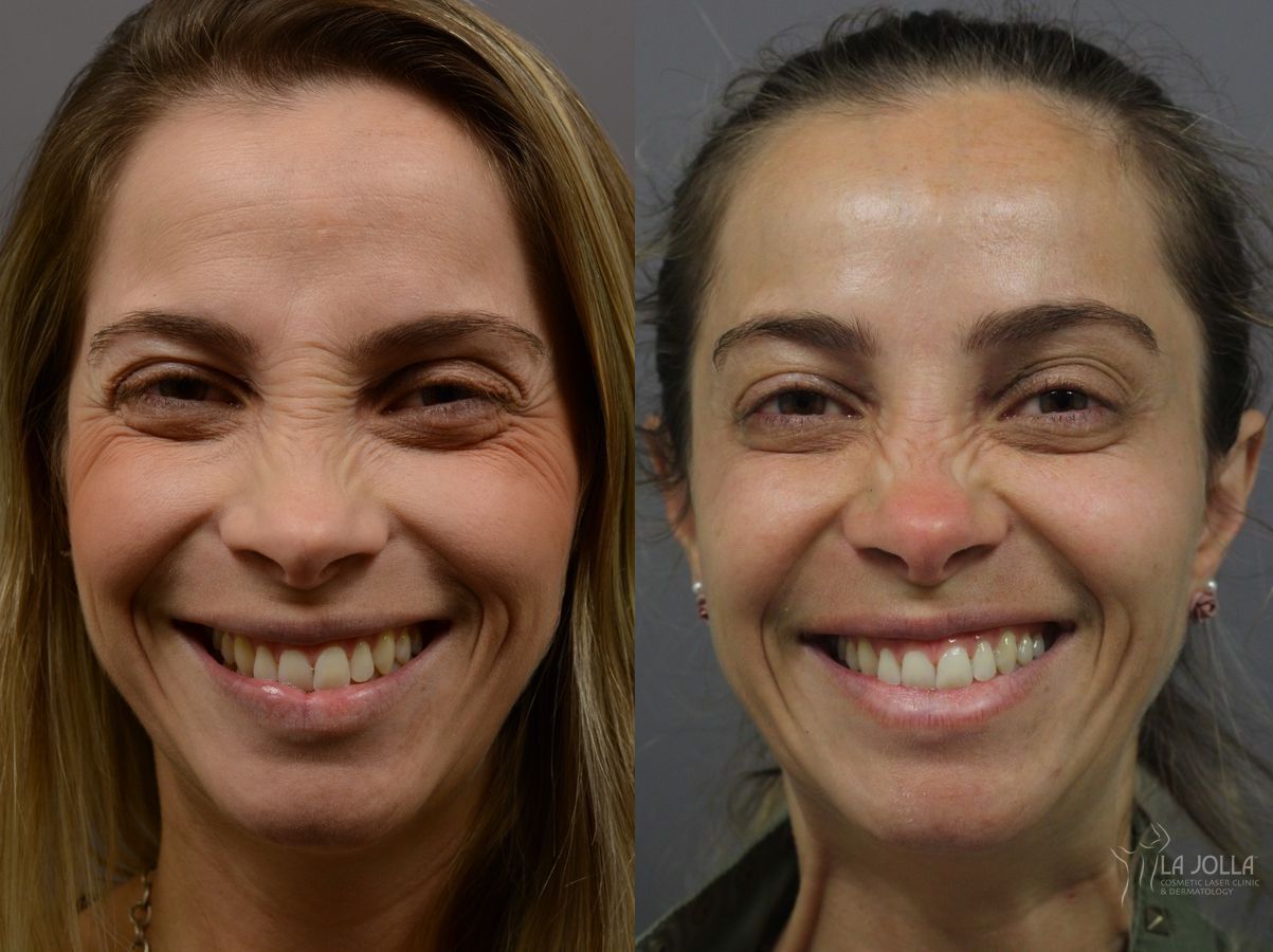 Before and after BOTOX® case 36401 - Angle 2