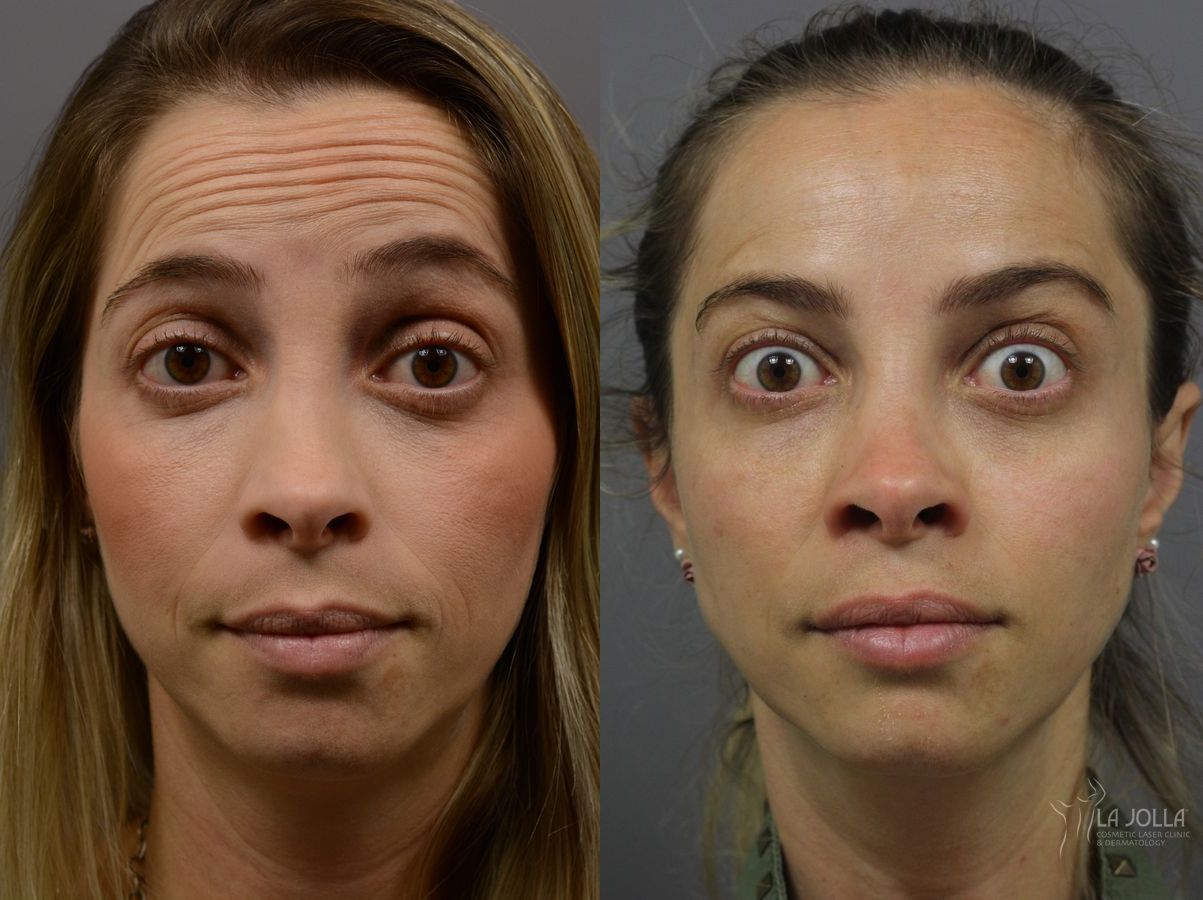 Before and after BOTOX® case 36401