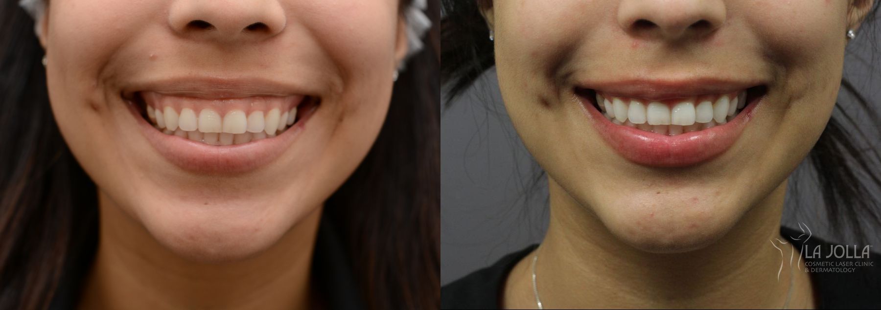 Before and after BOTOX® case 36435