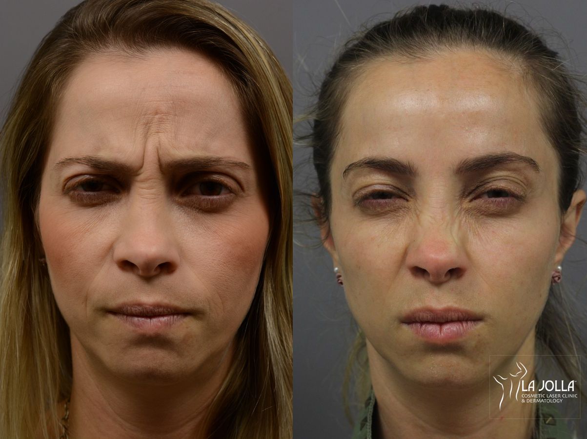 Before and after BOTOX® case 36401 - Angle 3