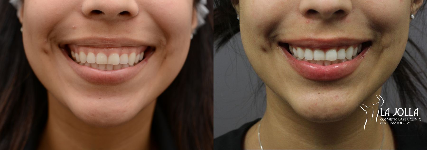 Before and after BOTOX® case 36435