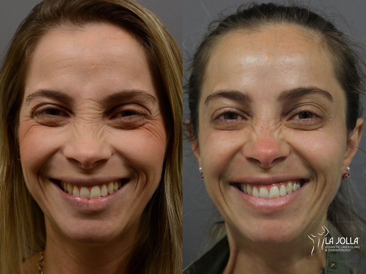 Before and after BOTOX® case 36401 - Angle 2