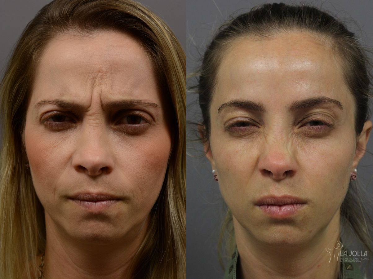 Before and after BOTOX® case 36401 - Angle 3