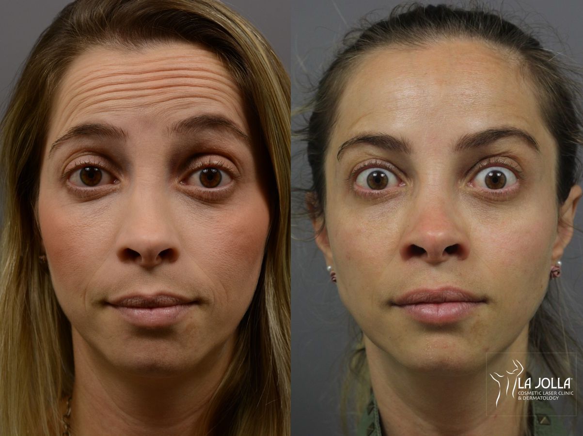 Before and after BOTOX® case 36401