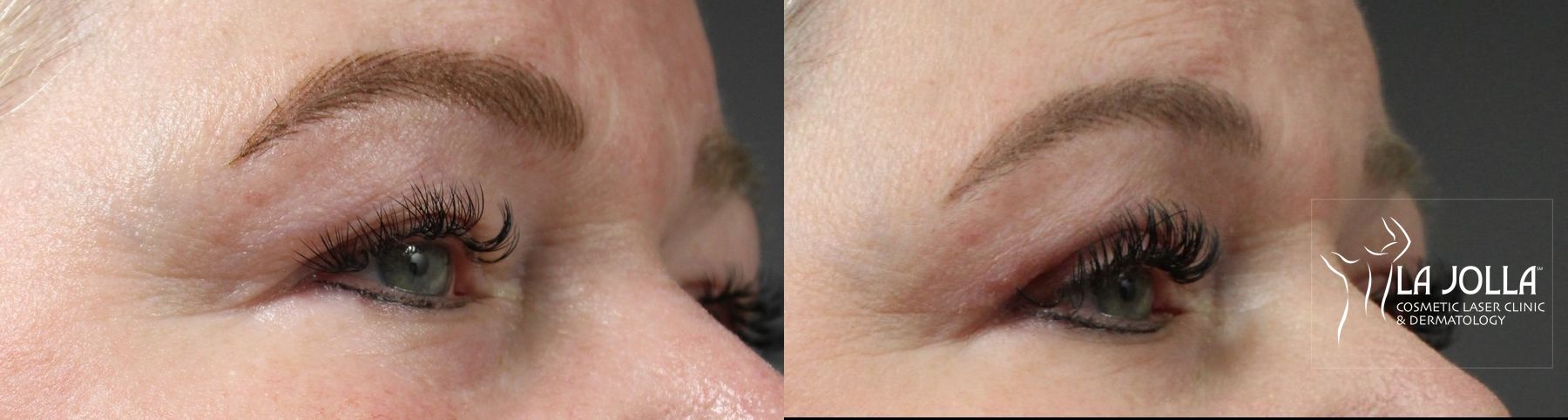 Before and after Blepharoplasty case 36383 - Angle 2