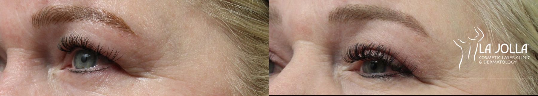 Before and after Blepharoplasty case 36383 - Angle 3