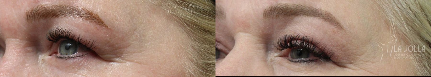Before and after Blepharoplasty case 36383 - Angle 3