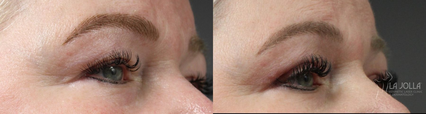 Before and after Blepharoplasty case 36383 - Angle 2
