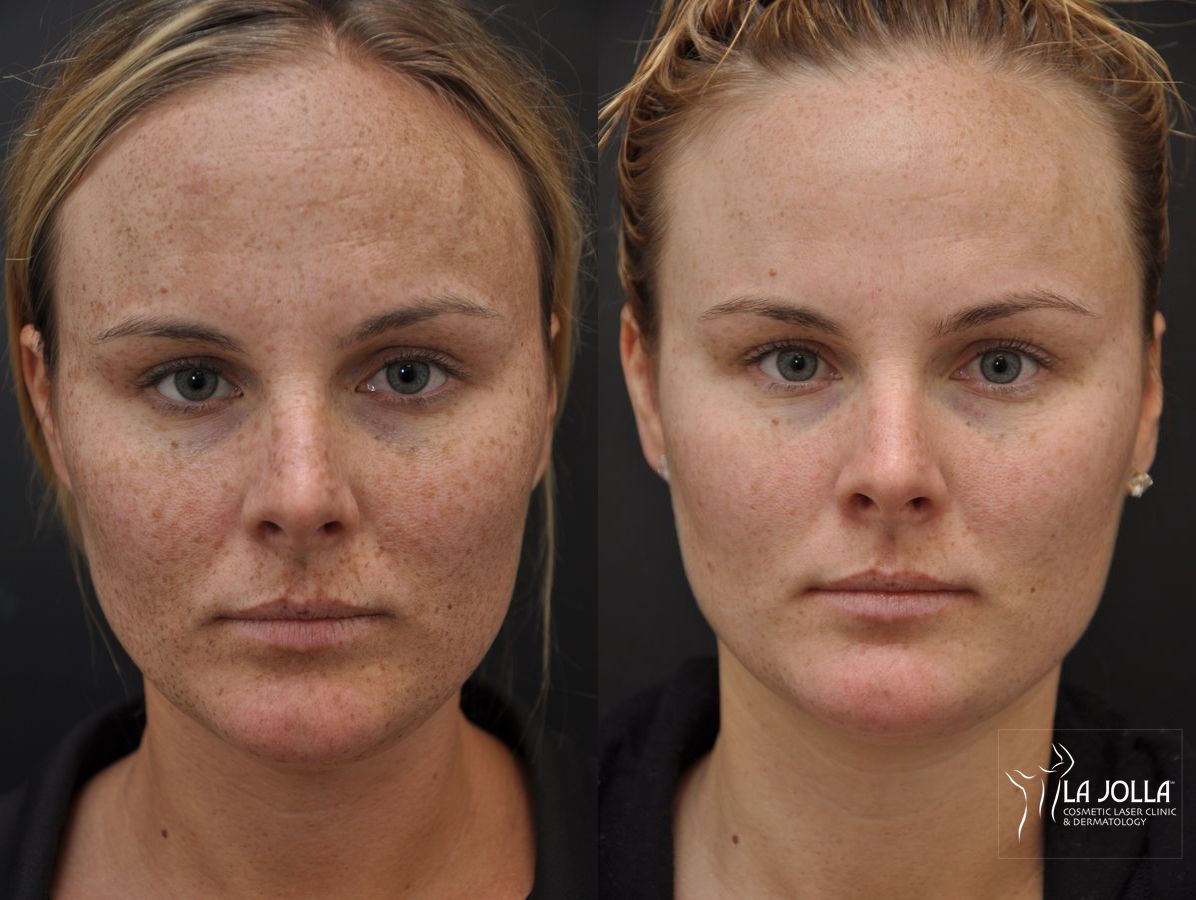 Before and after Chemical Peel case 36241