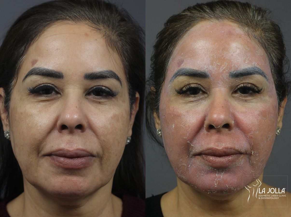 Before and after Chemical Peel case 36092