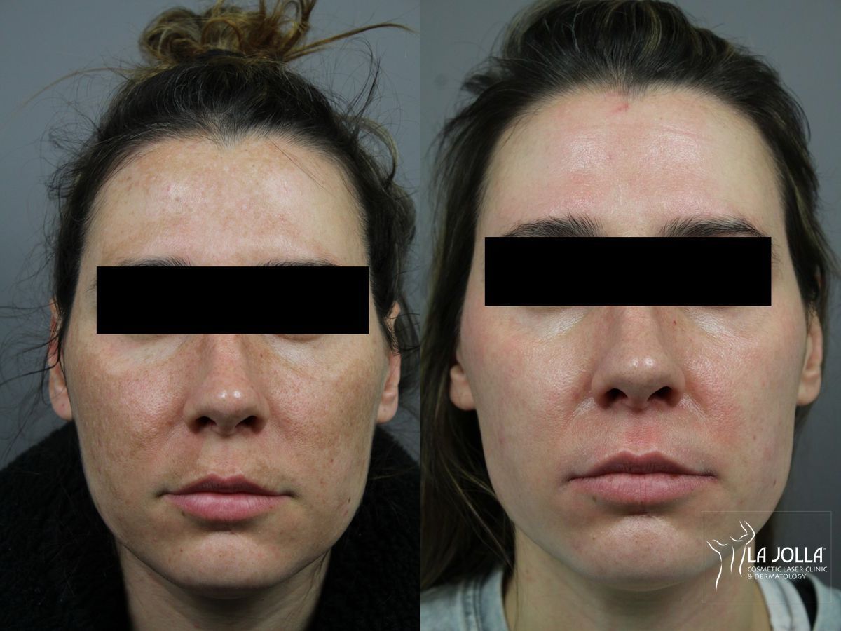 Before and after Chemical Peel case 36299