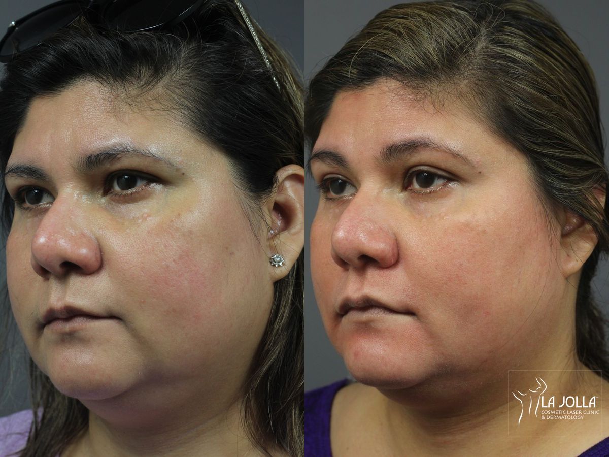 Before and after Chemical Peel case 36181