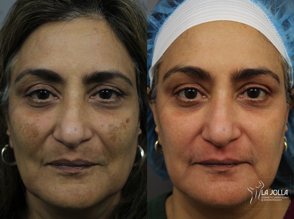 Before and after Chemical Peel case 36281
