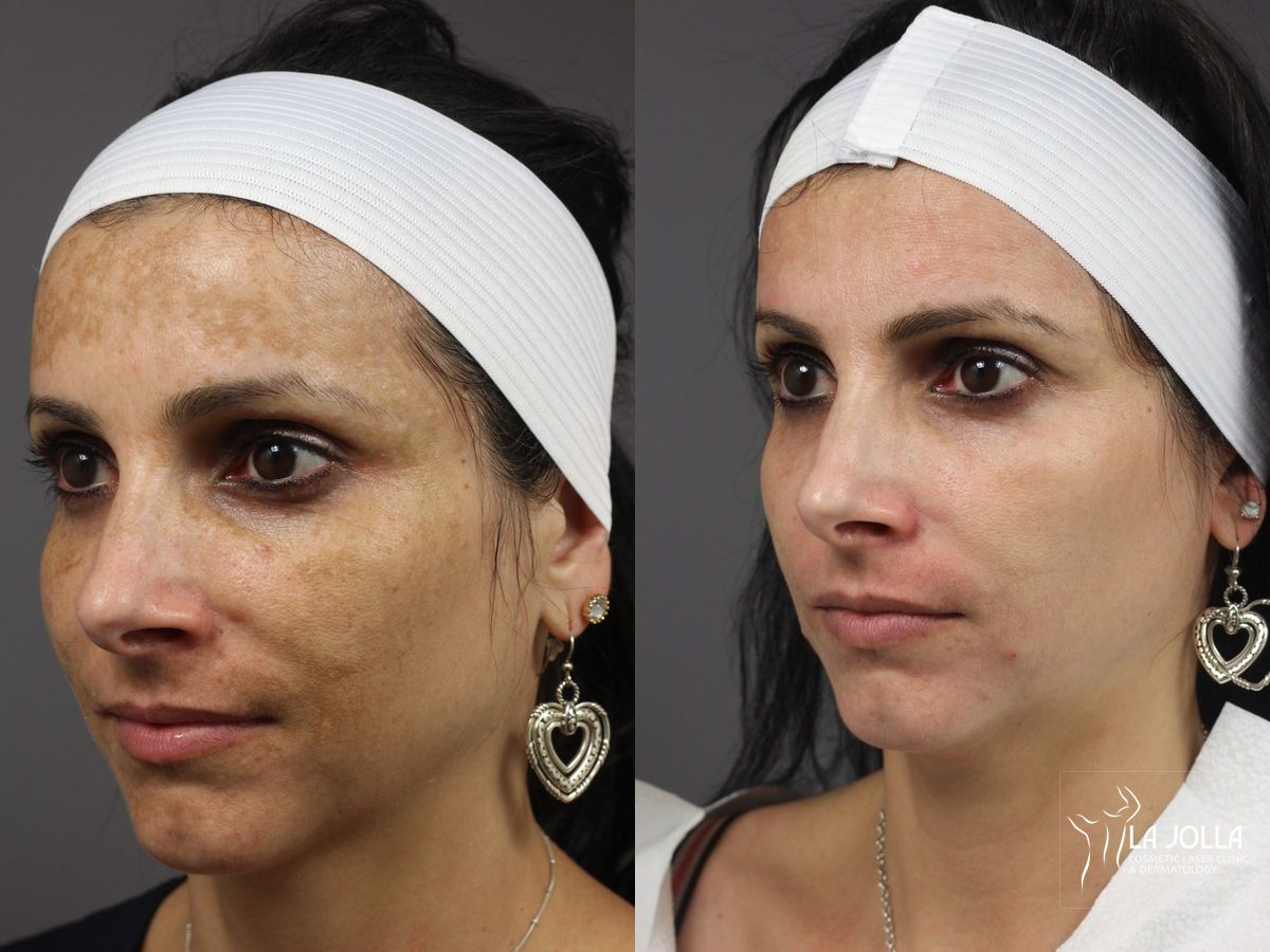 Before and after Chemical Peel case 36216