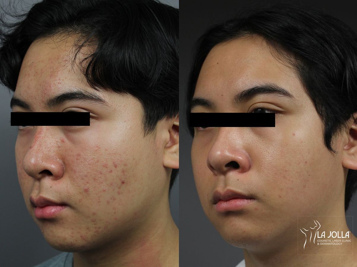 Before and after Chemical Peel case 36300 - Angle 2