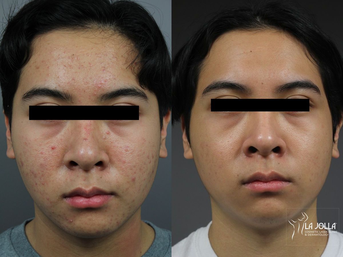 Before and after Chemical Peel case 36300