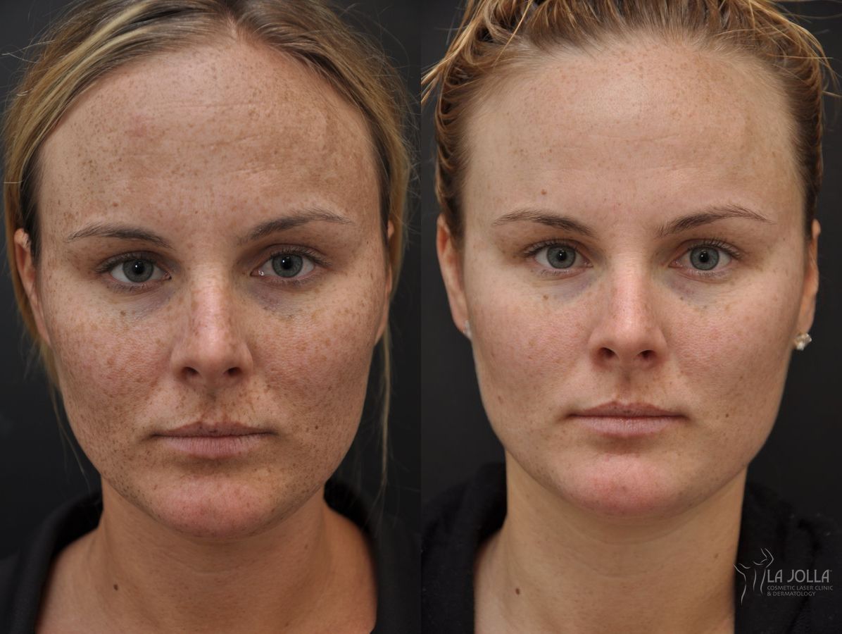 Before and after Chemical Peel case 36241