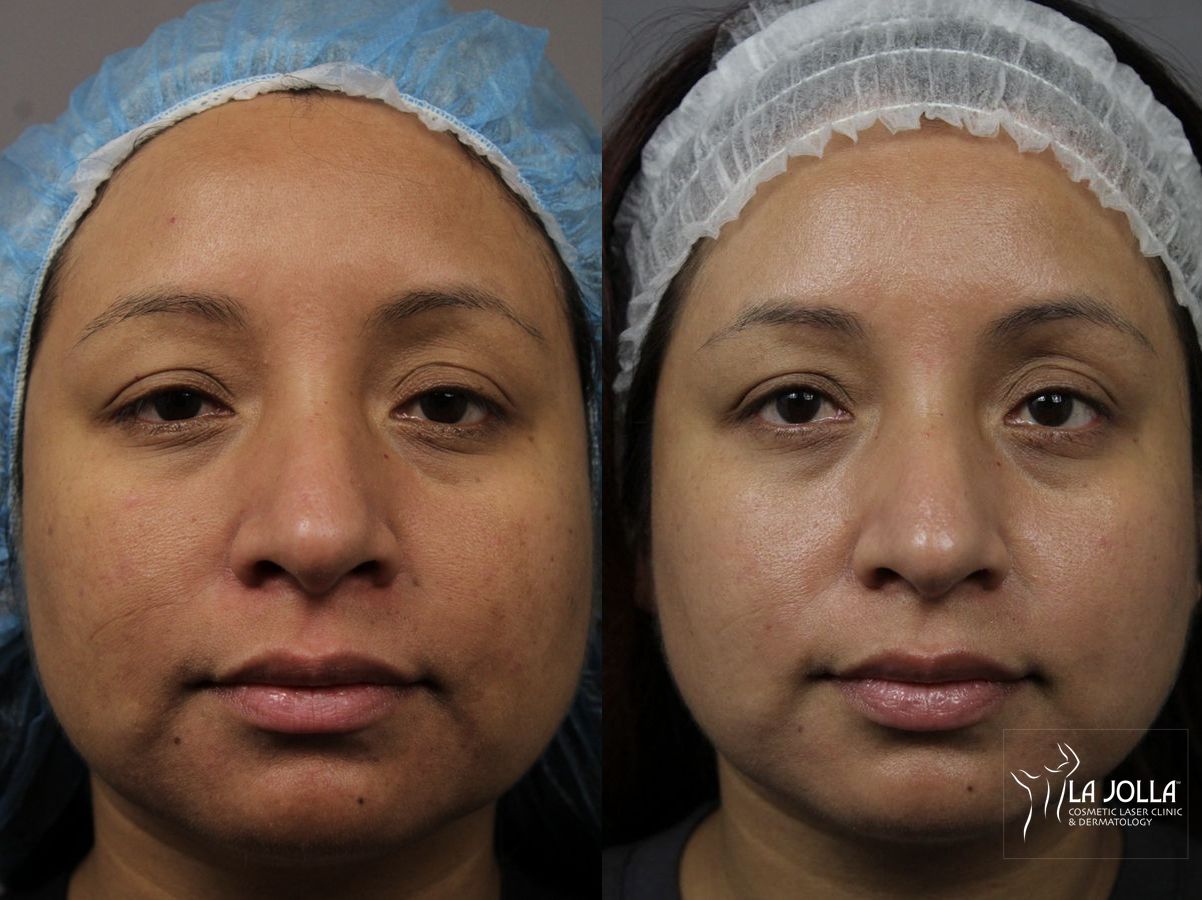 Before and after Chemical Peel case 36065