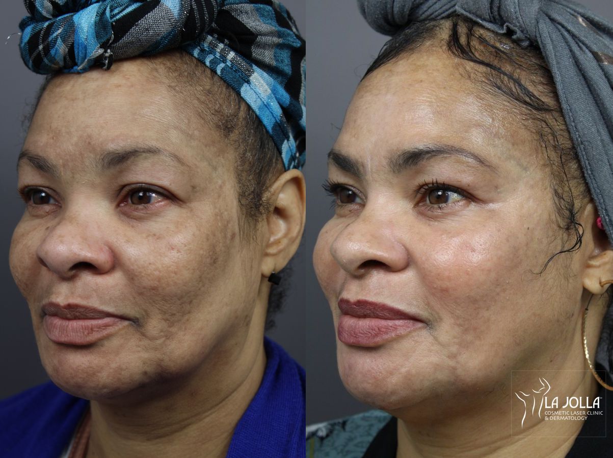 Before and after Chemical Peel case 36110