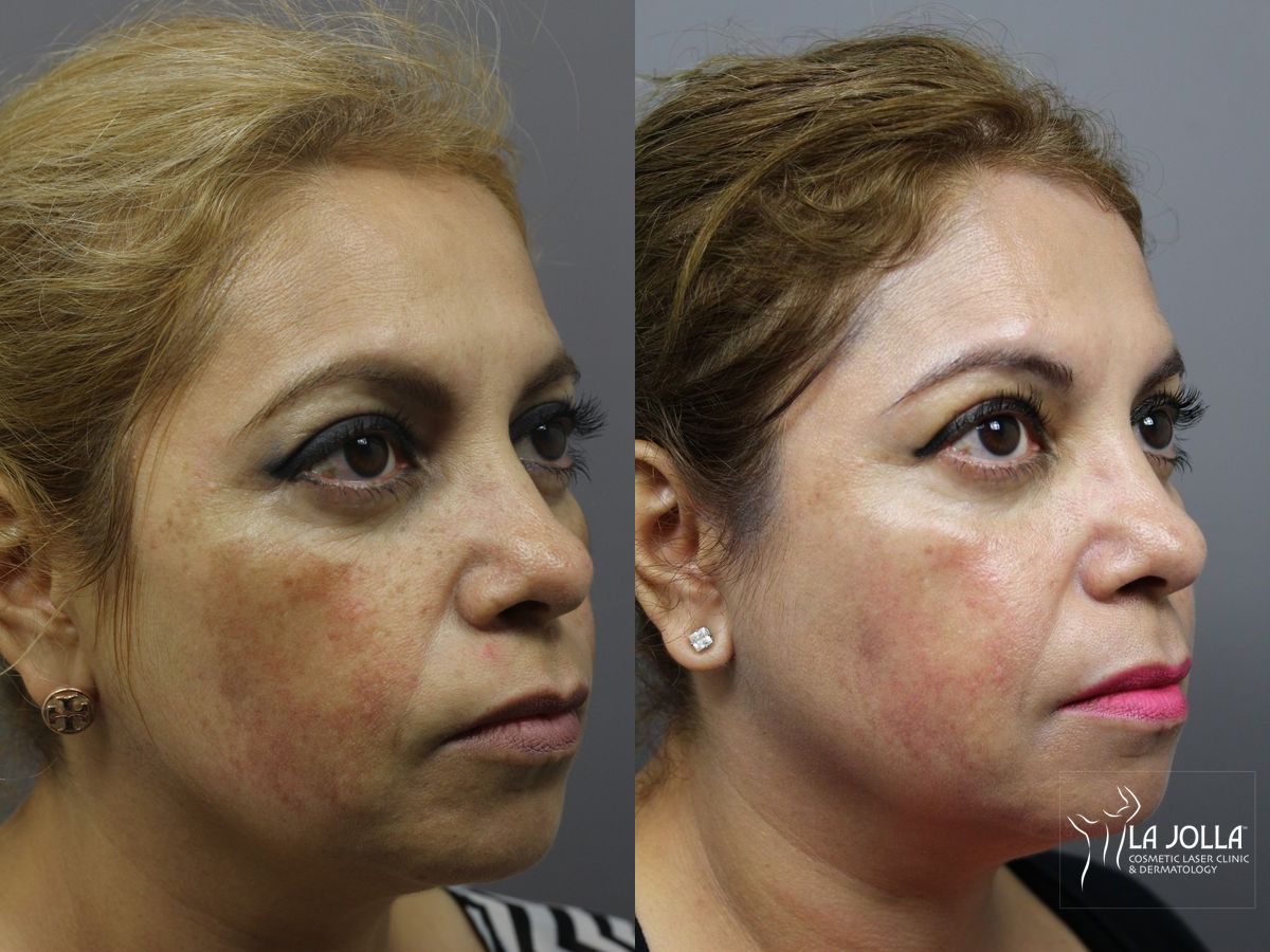 Before and after Chemical Peel case 36200 - Angle 2